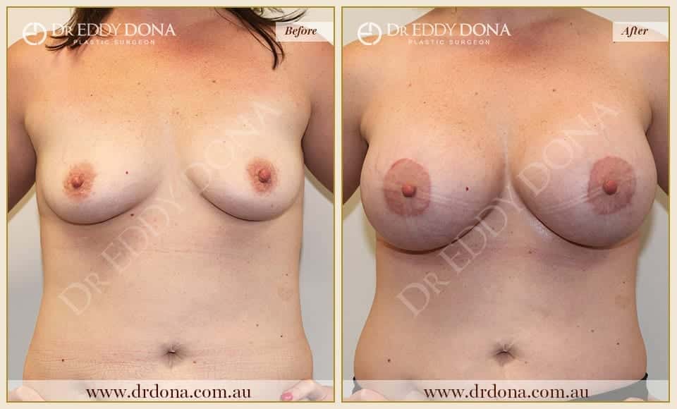 Dr Eddy Dona - Breast Lift and Implants Surgery - Before and After