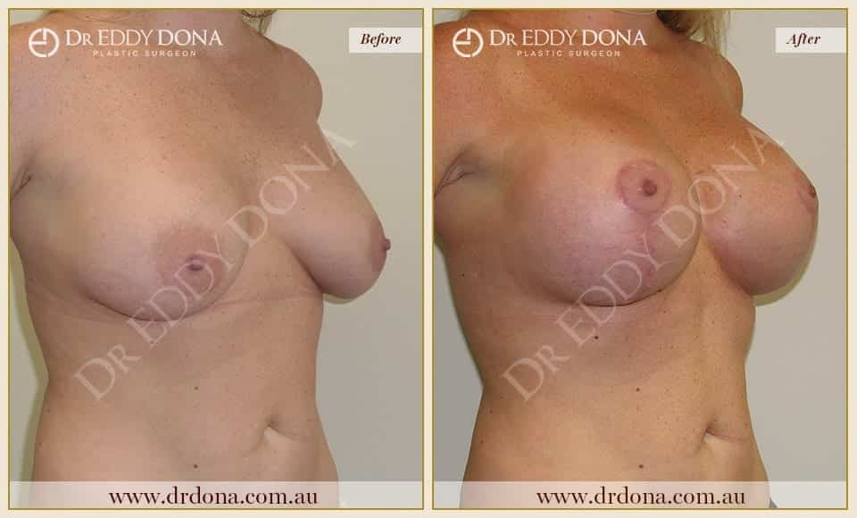 Dr Eddy Dona - Breast Lift and Implants Surgery - Before and After