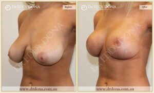 Dr Eddy Dona - Breast Lift Surgery - Before and After