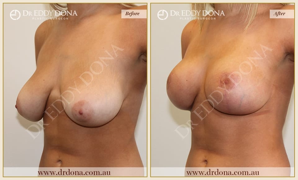 Dr Eddy Dona - Breast Lift Surgery - Before and After