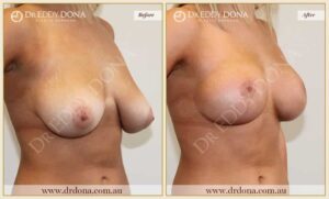 Dr Eddy Dona - Breast lift Surgery - Before and After