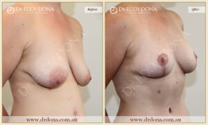 Dr Eddy Dona - Breast lift Surgery - Before and After