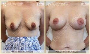 Dr Eddy Dona - Breast Lift and Implants Surgery - Before and After