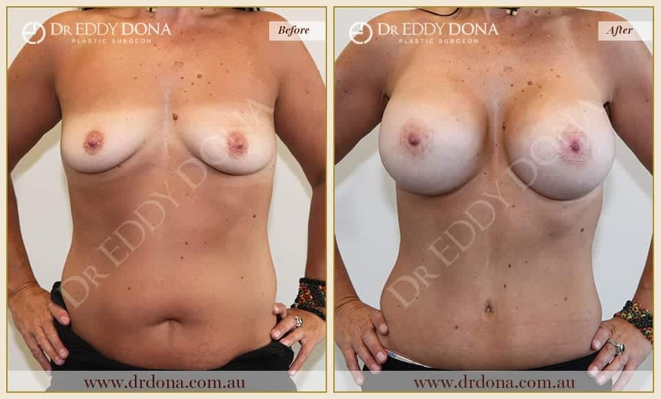 Dr Eddy Dona Before and After Mummy Makeover