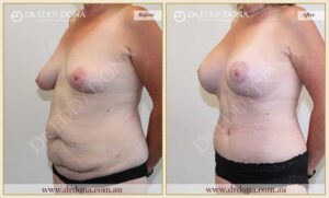 Dr Eddy Dona Before and After Mummy Makeover