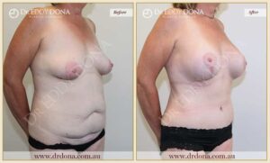 Dr Eddy Dona Before and After Mummy Makeover