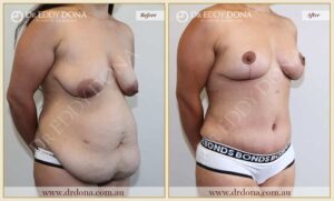 Dr Eddy Dona Before and After Mummy Makeover