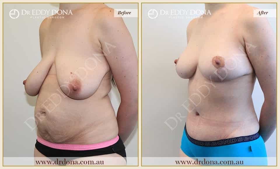 Dr Eddy Dona Before and After Mummy Makeover