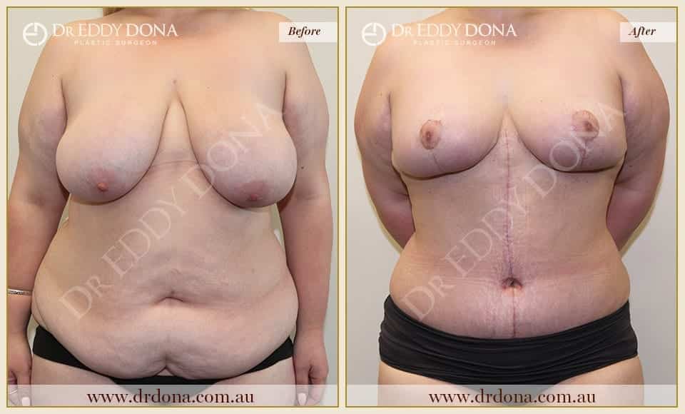 Dr Eddy Dona Before and After Mummy Makeover