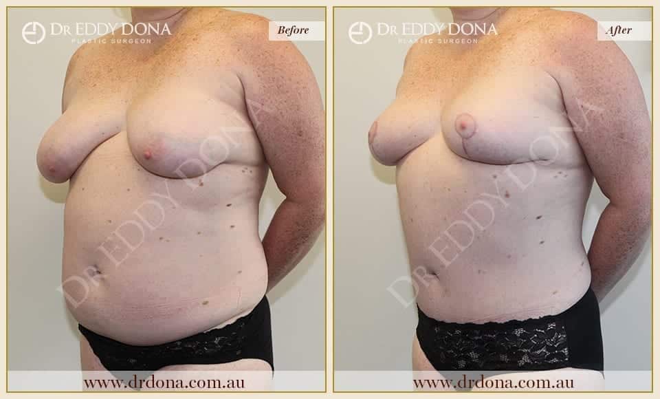 Dr Eddy Dona Before and After Mummy Makeover