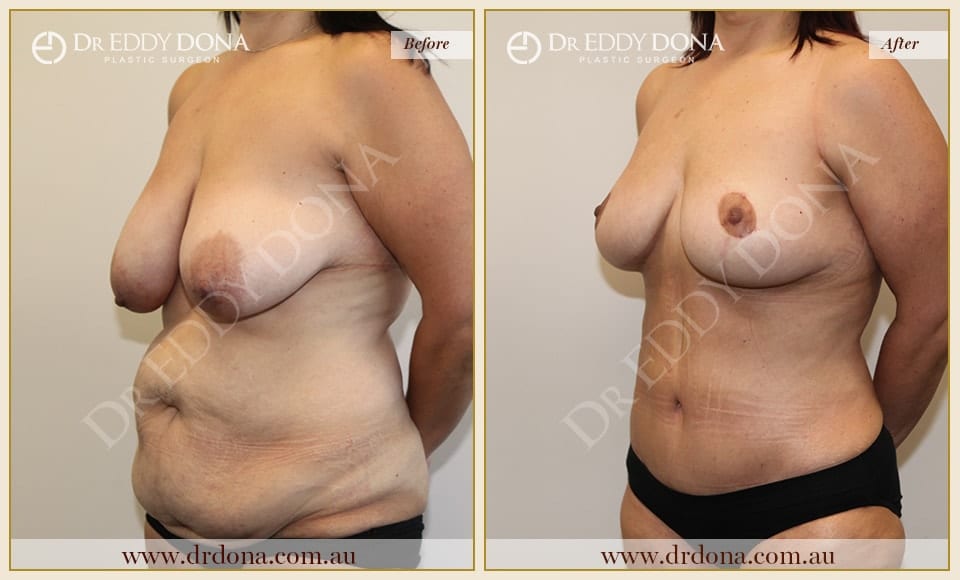 Dr Eddy Dona Before and After Mummy Makeover