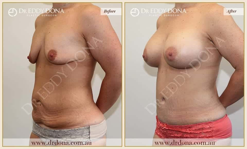 Dr Eddy Dona Before and After Mummy Makeover