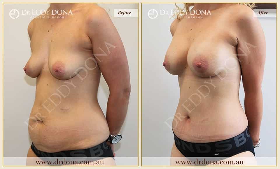 Dr Eddy Dona Before and After Mummy Makeover