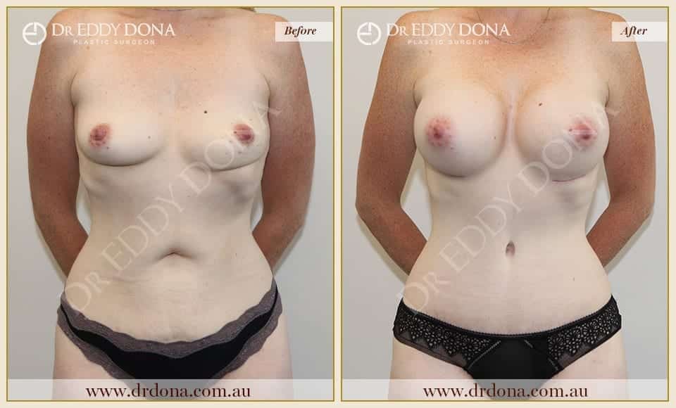 Dr Eddy Dona Before and After Mummy Makeover