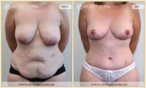 Dr Eddy Dona Before and After Mummy Makeover