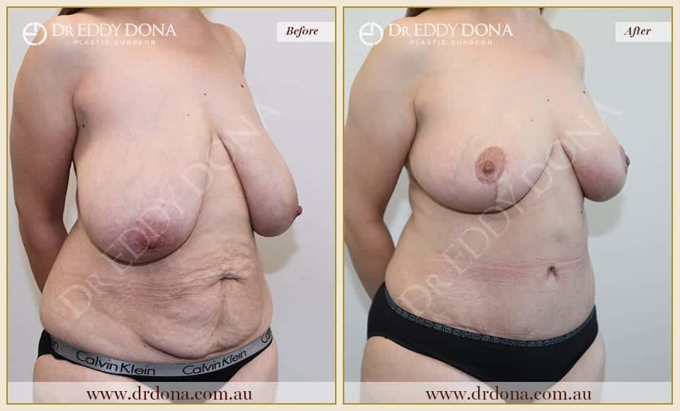 Dr Eddy Dona Before and After Mummy Makeover