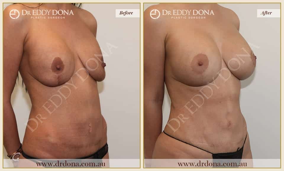 Dr Eddy Dona - Mummy Makeover - Before and After