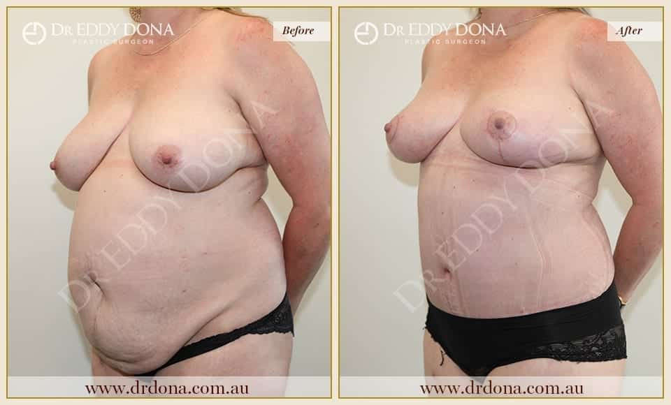 Dr Eddy Dona Before and After Mummy Makeover