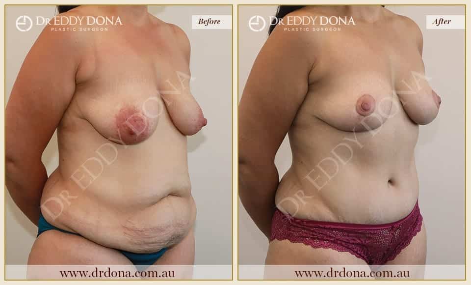 Dr Eddy Dona - Mummy Makeover - Before and After