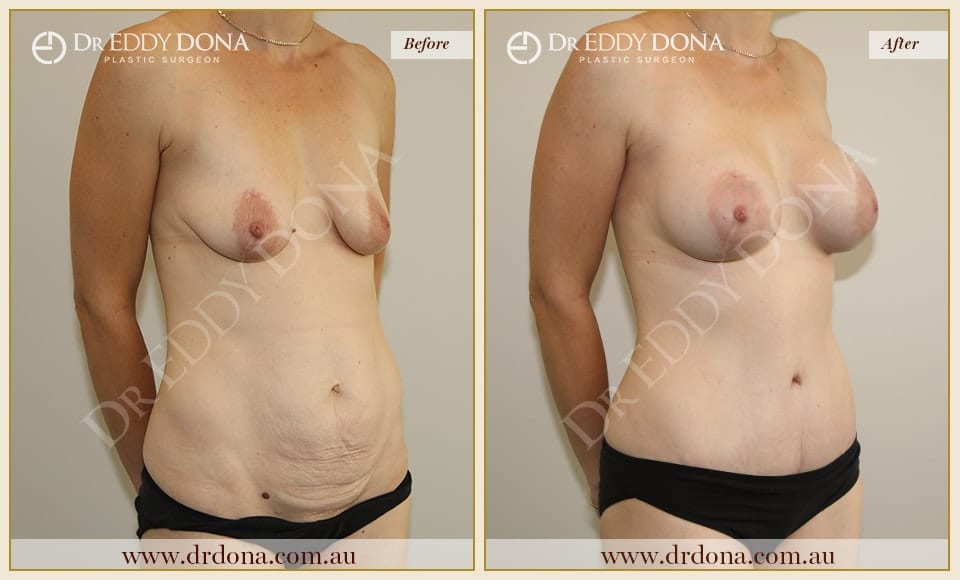 Dr Eddy Dona - Mummy Makeover - Before and After