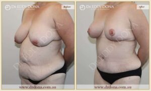 Dr Eddy Dona - Mummy Makeover - Before and After