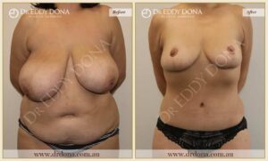 Dr Eddy Dona - Mummy Makeover - Before and After