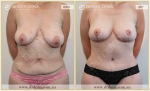 Dr Eddy Dona Mummy Makeover Before and After