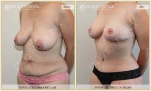 Dr Eddy Dona Mummy Makeover Before and After