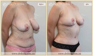 Dr Eddy Dona Mummy Makeover Before and After