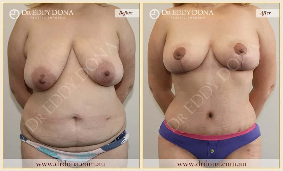 Dr Eddy Dona - Mummy Makeover - Before and After