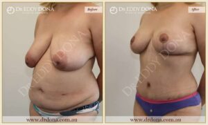 Dr Eddy Dona - Mummy Makeover - Before and After