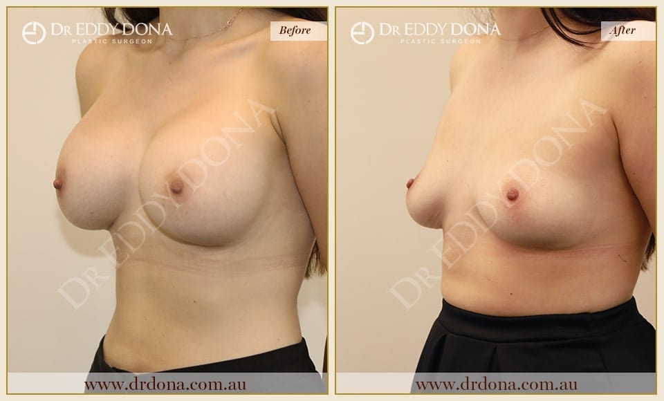 Dr Eddy Dona - Removal of Implants