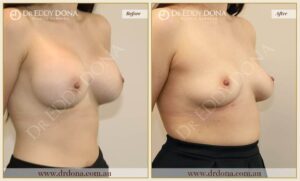 Dr Eddy Dona - Removal of Implants