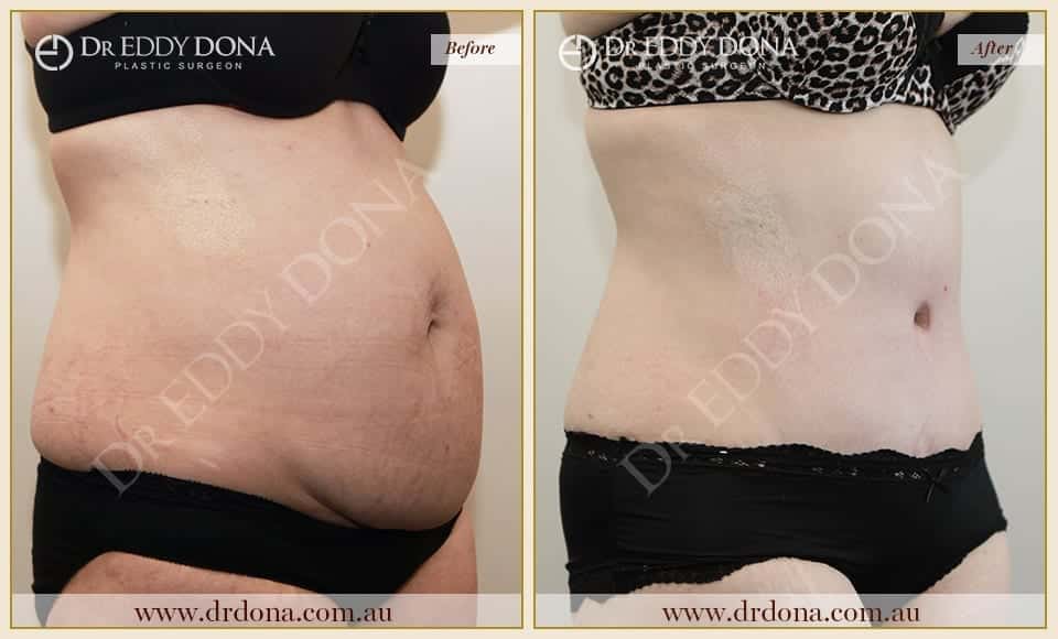 Dr Eddy Dona Plastic Surgery Tummy Tuck Before and After Right Oblique