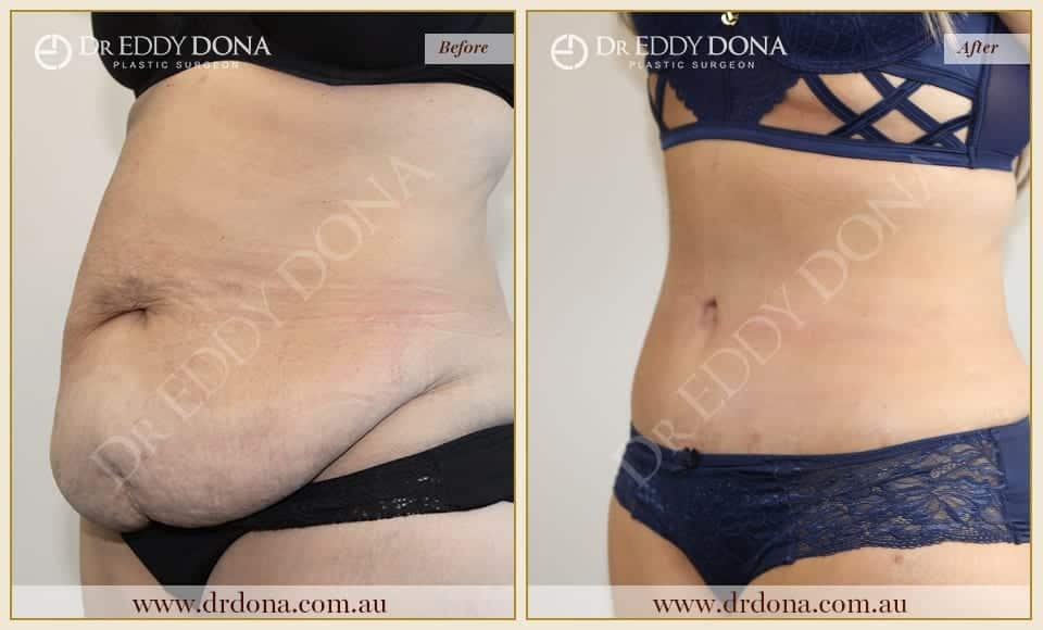 Dr Eddy Dona Plastic Surgery Tummy Tuck Before and After Left Oblique