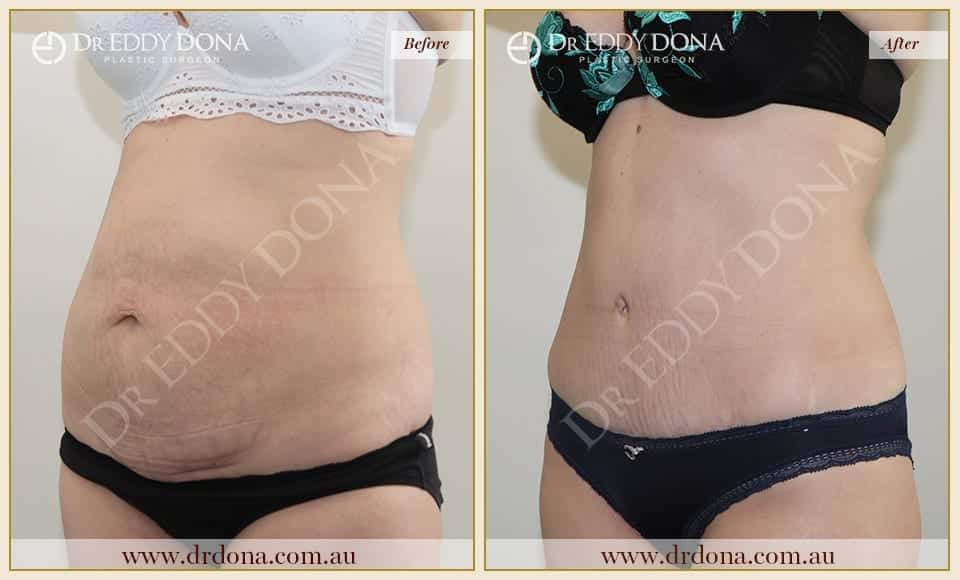 Dr Eddy Dona - Tummy Tuck - Before and After