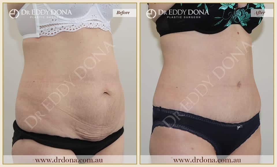 Dr Eddy Dona - Tummy Tuck - Before and After