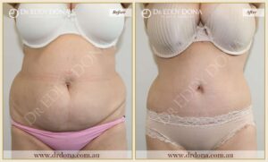 Dr Eddy Dona - Tummy Tuck - O9006 F