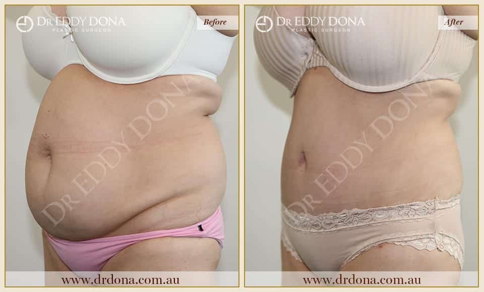 Dr Eddy Dona - Tummy Tuck - O9006 F