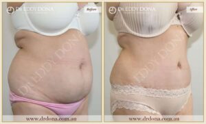 Dr Eddy Dona - Tummy Tuck - O9006 F