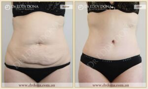 Dr Eddy Dona - Tummy Tuck - Before and After