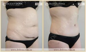 Dr Eddy Dona - Tummy Tuck - Before and After