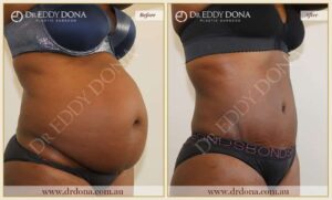 Dr Eddy Dona - Tummy Tuck - Before and After