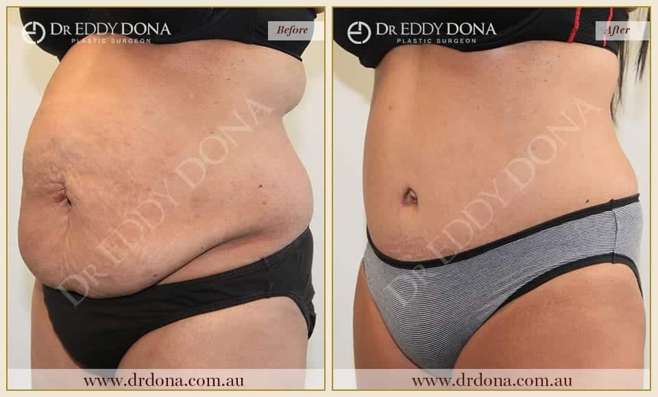 Dr Eddy Dona Plastic Surgery Tummy Tuck Before and After Left Oblique