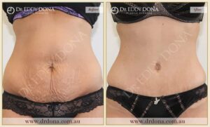 Dr Eddy Dona Plastic Surgery Tummy Tuck Before and After Frontal