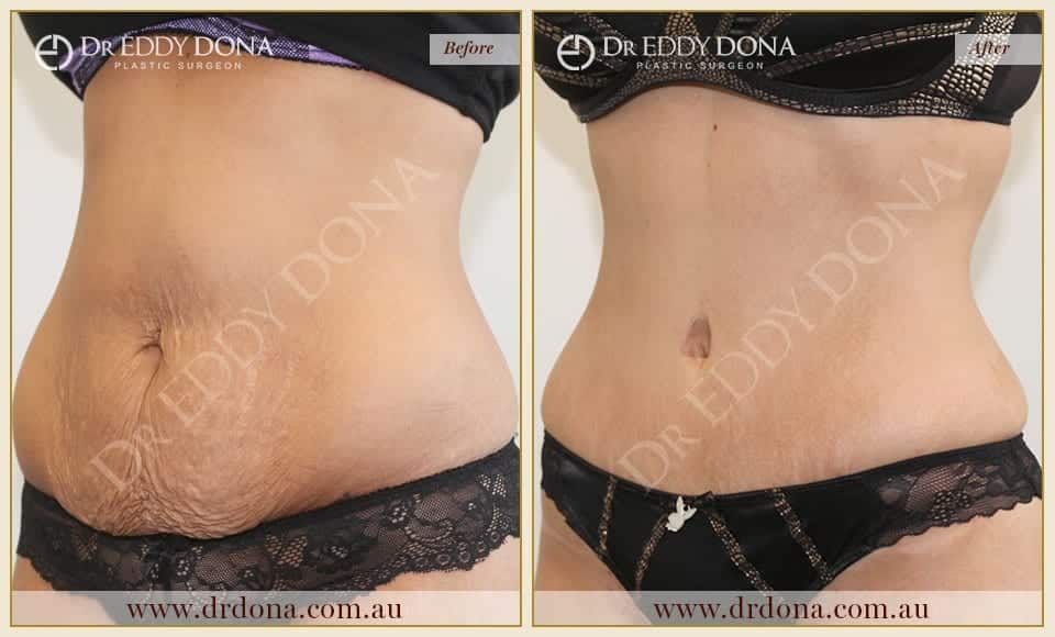 Dr Eddy Dona Plastic Surgery Tummy Tuck Before and After Left Oblique