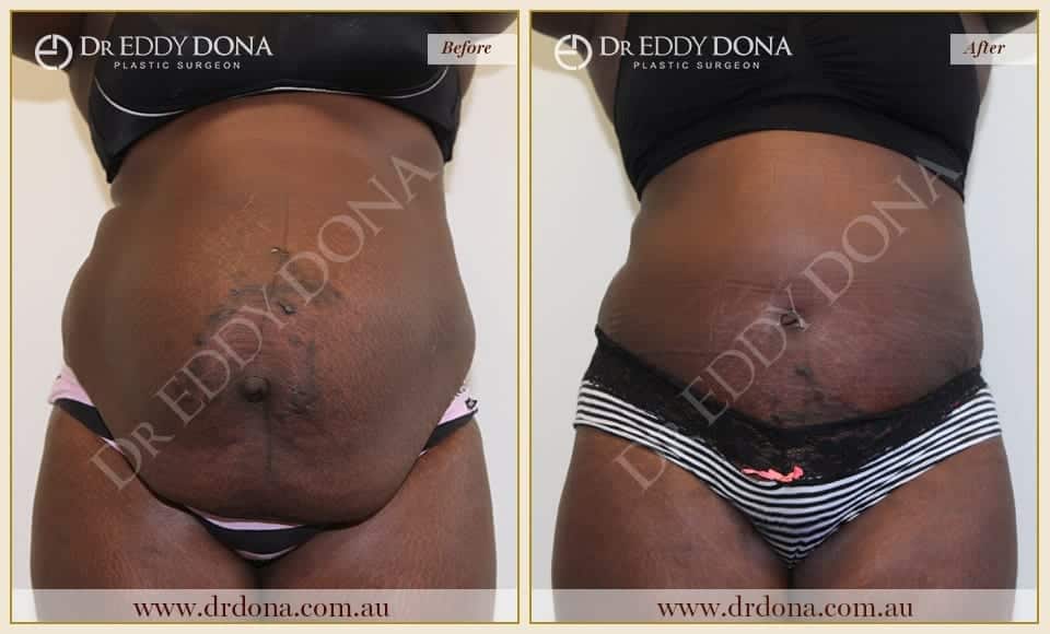 Dr Eddy Dona Plastic Surgery Tummy Tuck Before and After Frontal