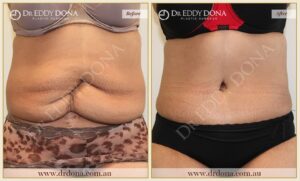 Dr Eddy Dona Plastic Surgery Tummy Tuck Before and After Frontal