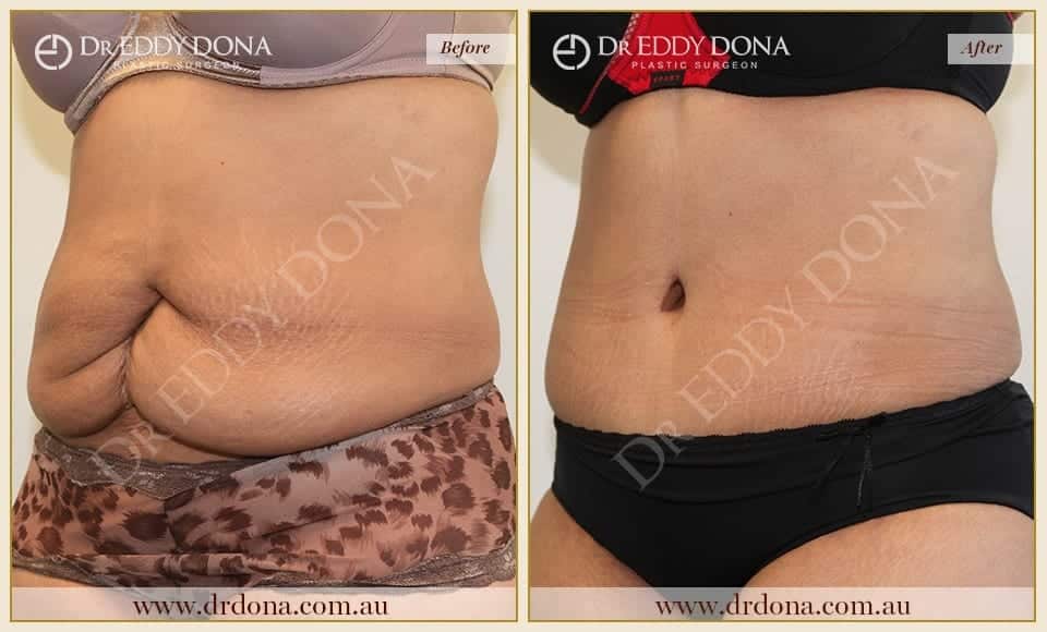 Tummy Tuck Surgery Before And After Gallery