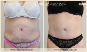 Dr Eddy Dona Plastic Surgery Tummy Tuck Before and After Frontal